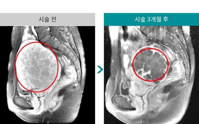 민트병원_자궁근종 색전술3.png