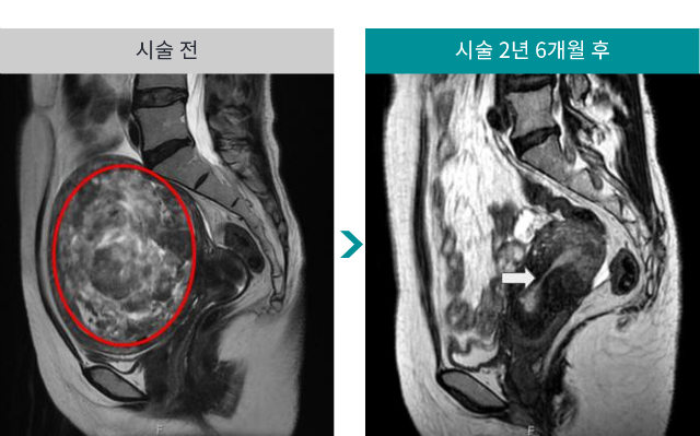 민트병원_자궁근종 색전술4.png