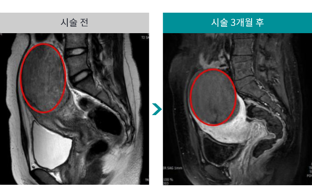 민트병원_자궁근종 색전술8.png