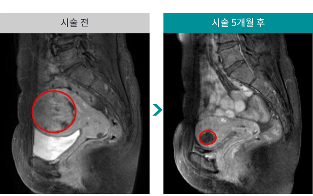 민트병원_자궁근종 색전술9.png