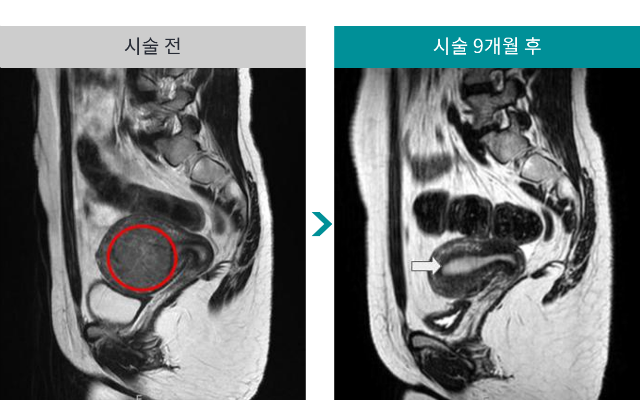 민트병원_자궁근종 색전술11.png