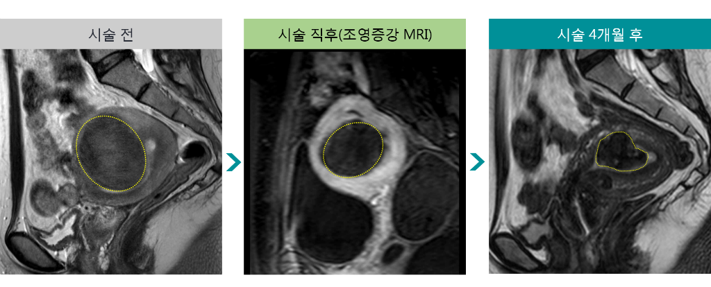 민트병원_MR하이푸1_44세 생리과다(시술직후 포함).png