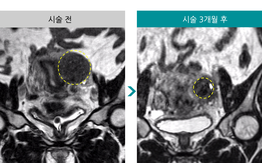 43세하이푸후3개월변화.jpg