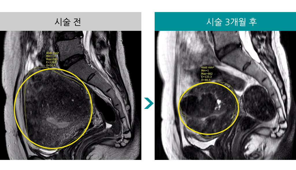 색전술후3개월변화.jpg