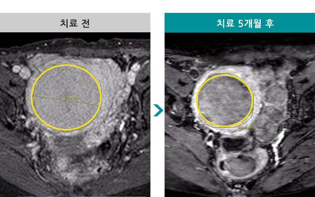 53세커지는근종색전술.jpg