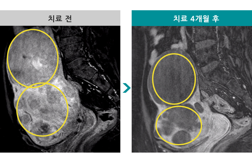 40세다발성근종색전술.jpg