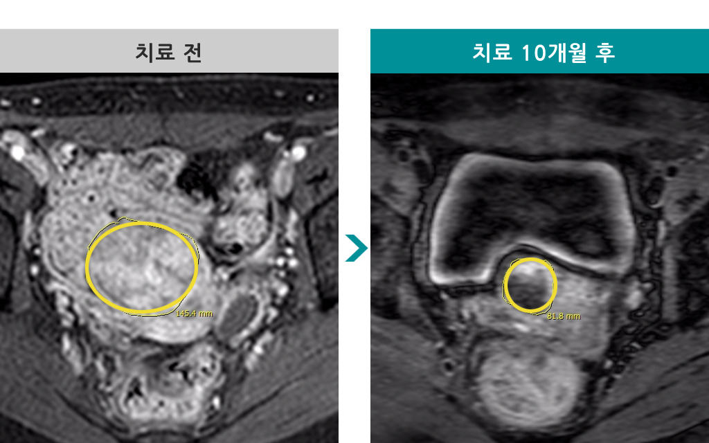 30세미혼색전술.jpg