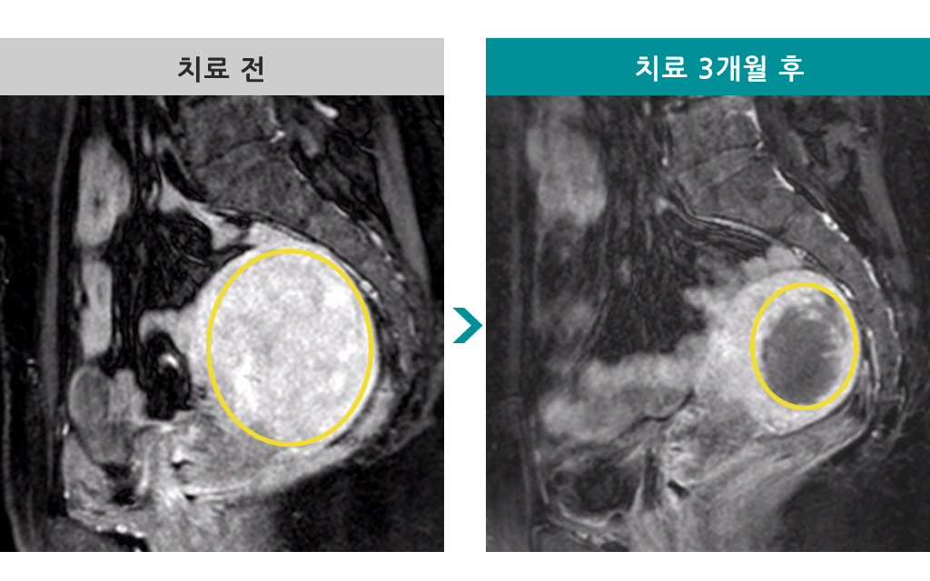 44세미만성선근증색전술.jpg