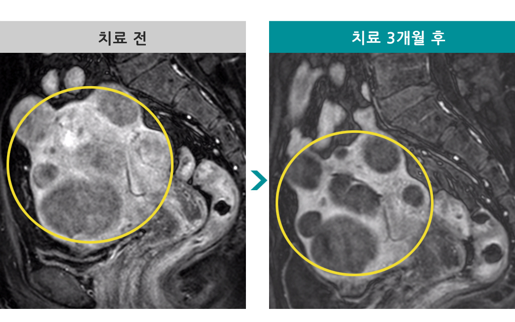 52세다발성근종색전술.jpg