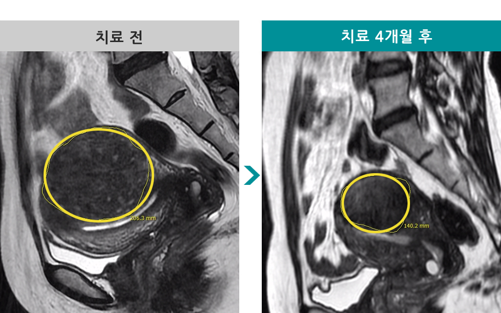 45세선근증색전술.jpg