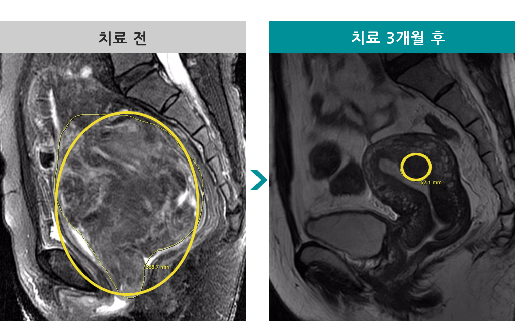 39거대흐르는근종.jpg