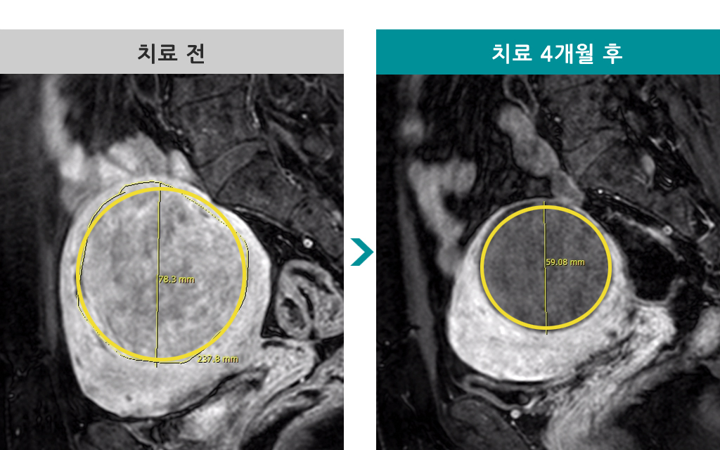 46세근육내근종색전술.jpg