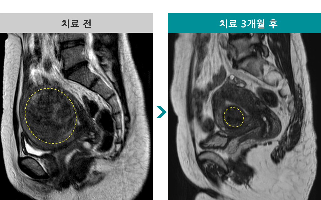 45세점막하하이푸.jpg