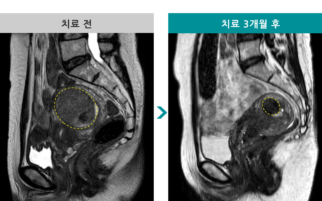 46MR하이푸.jpg