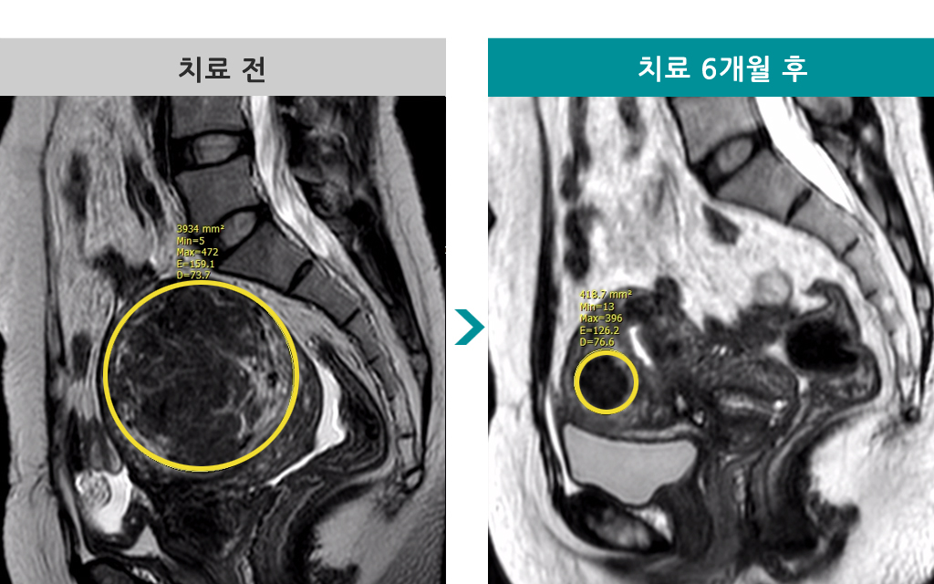 39세근종색전술.jpg