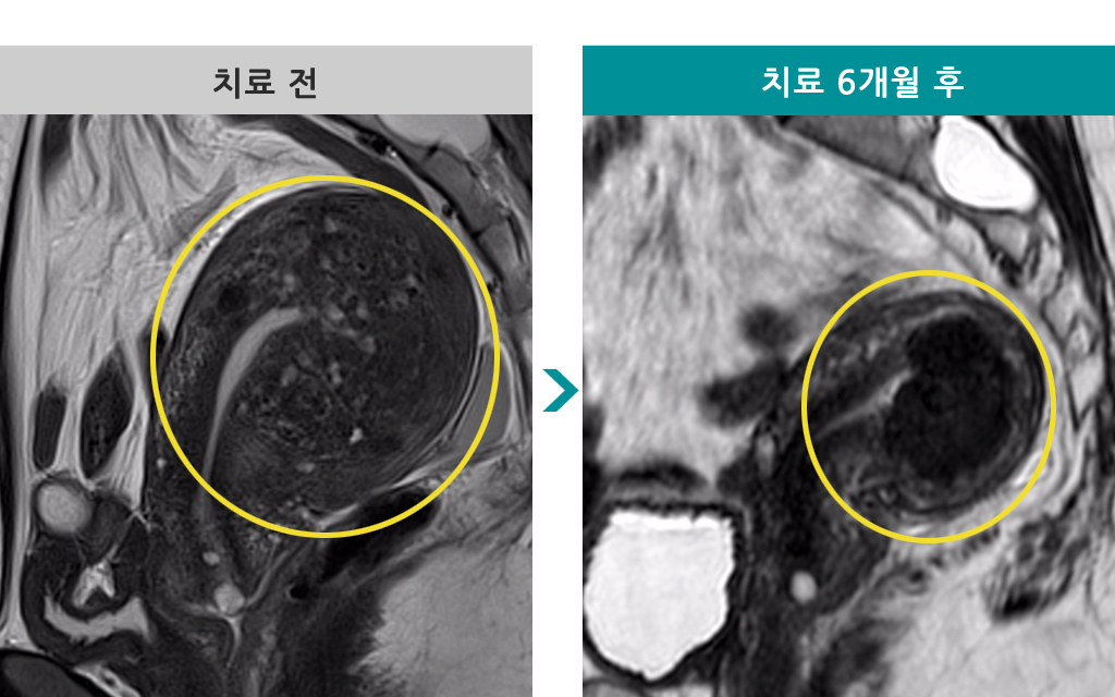 42세미만선선근증색전술.jpg