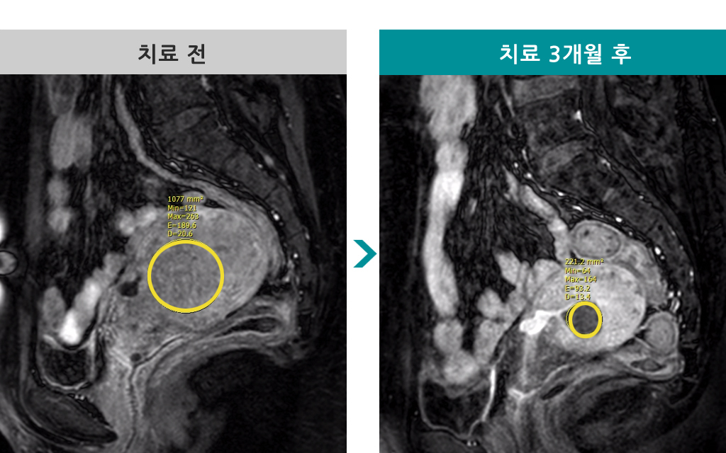 46세국소선근증.jpg