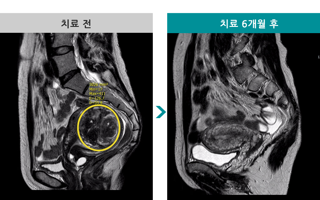 43세점막하근종색전술.jpg