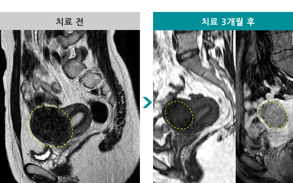 28하이푸점막하근종.jpg