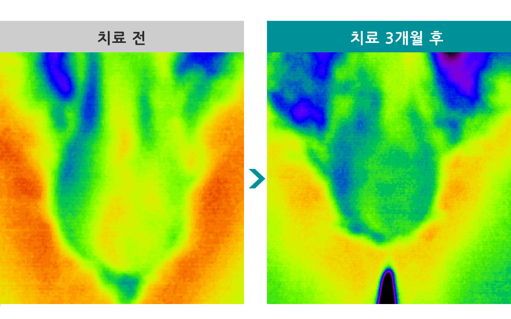 31정계정맥류.jpg