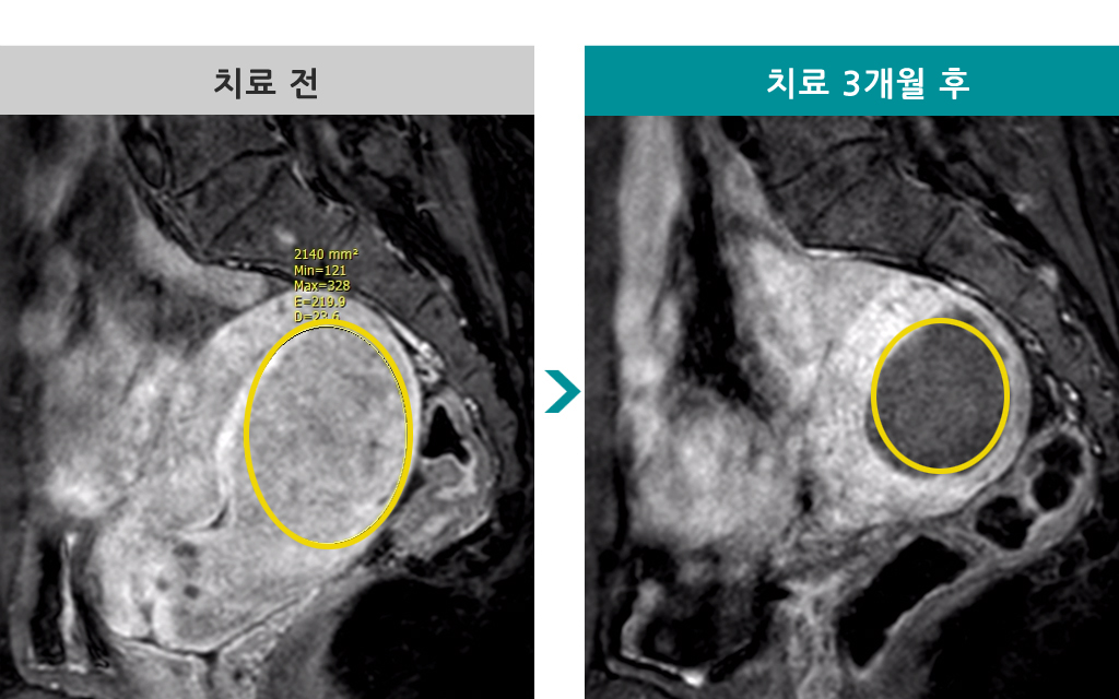 48세선근증색전술.jpg