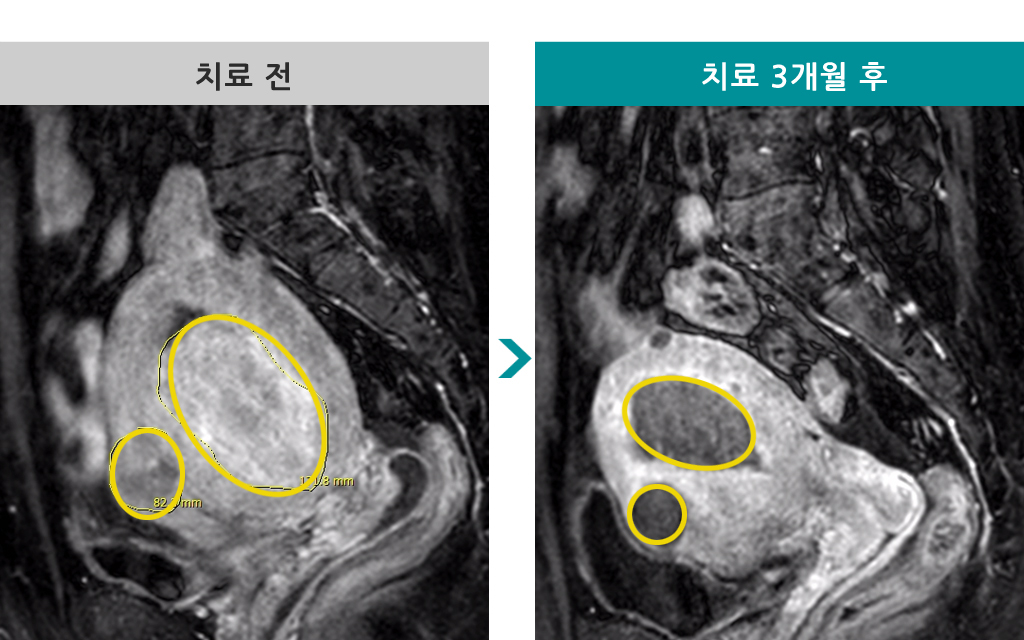 46세색전술다발성.jpg