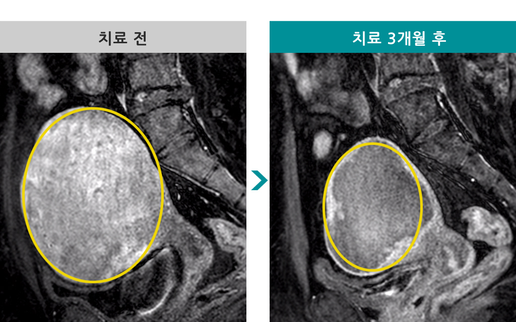 37세미만성선근증색전술.jpg