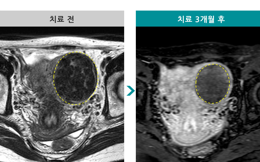 43세하이푸.jpg