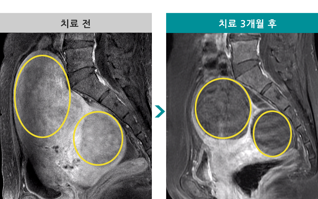 46세다발성거대색전술.jpg