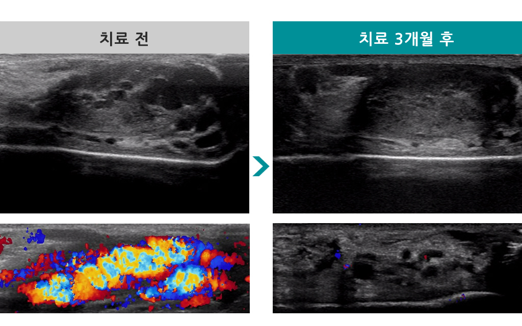 45세정계무정자증.jpg