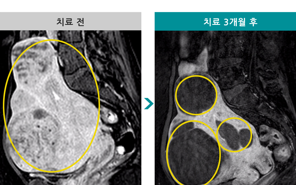 48세색전술다발성.jpg