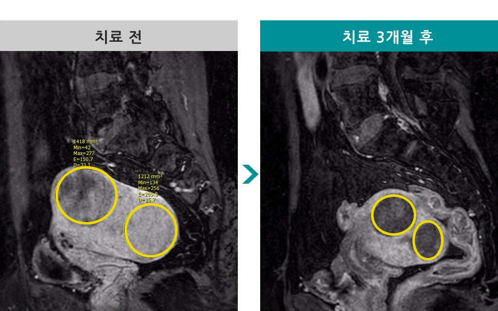 46세근종선근증색전술.jpg