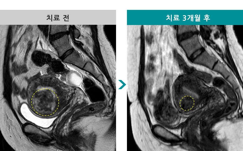 44세하이푸.jpg