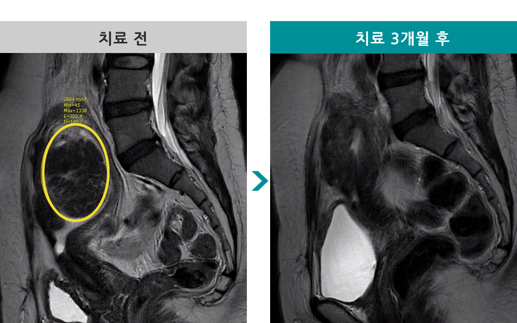 38점막하색전술.jpg