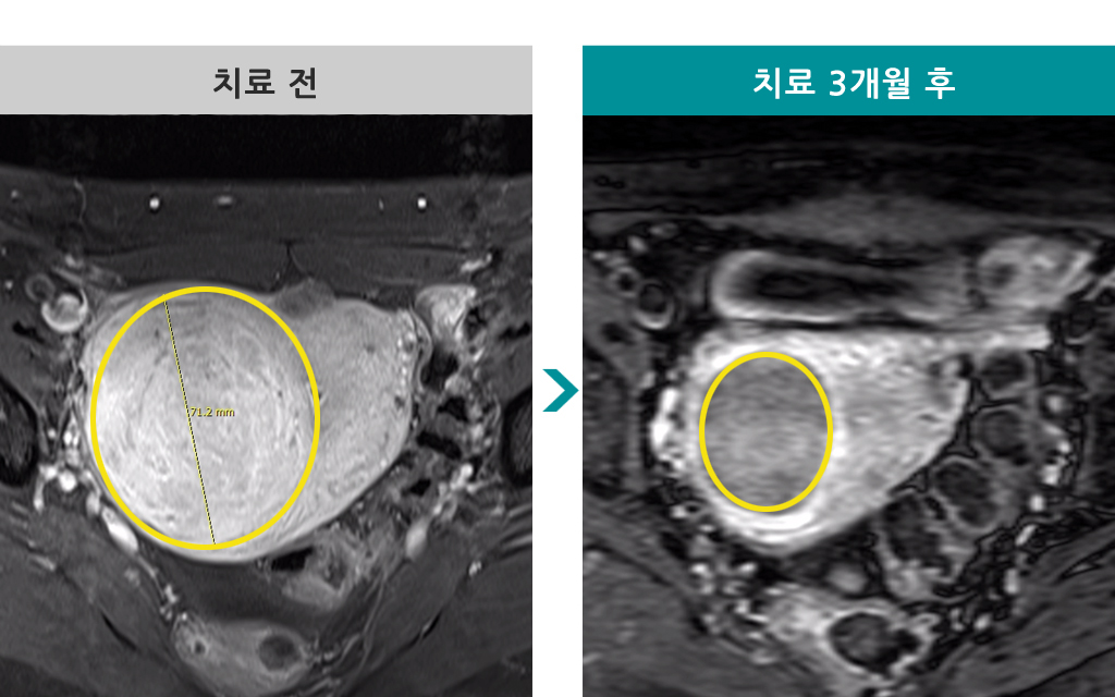 40세근종색전술.jpg