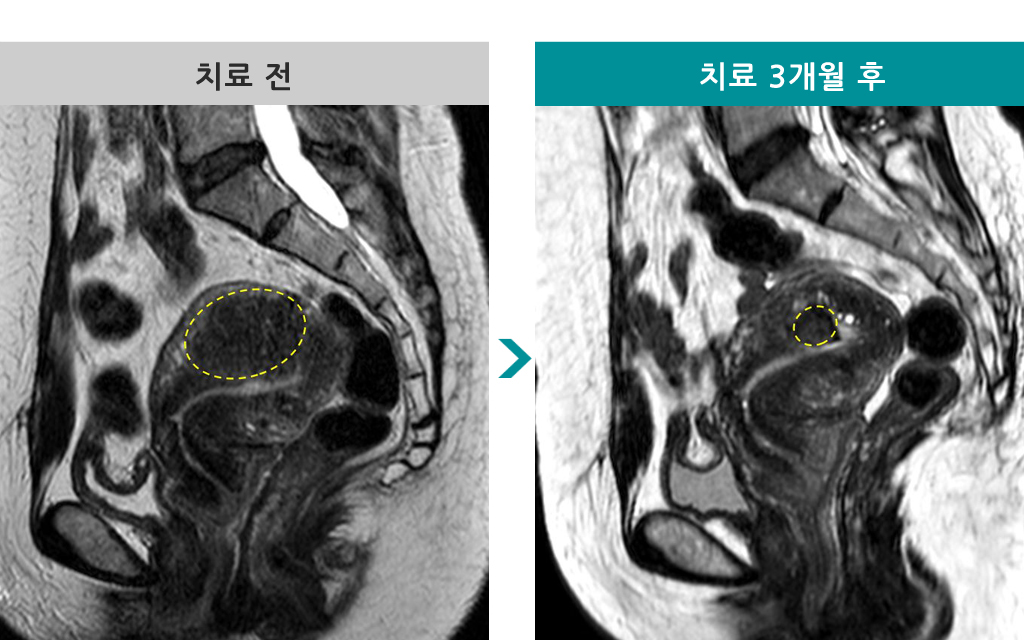 43엠알하이푸.jpg