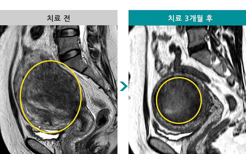 44세점막하선근증.jpg