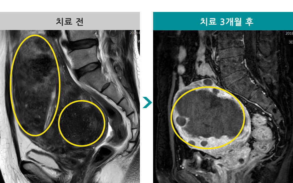 51세근종선근증색전술.jpg