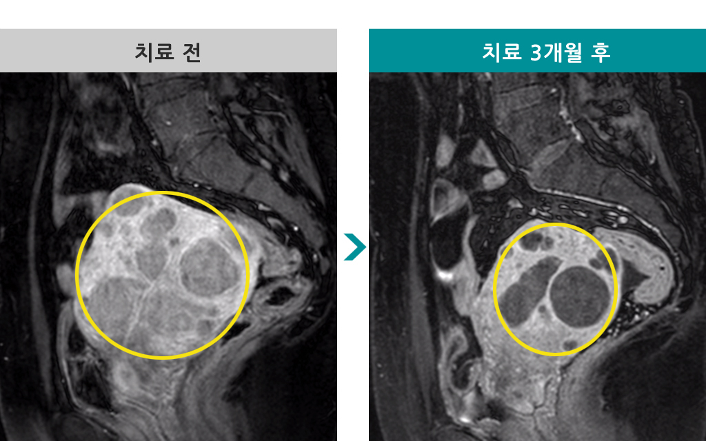 41세다발성색전술.jpg