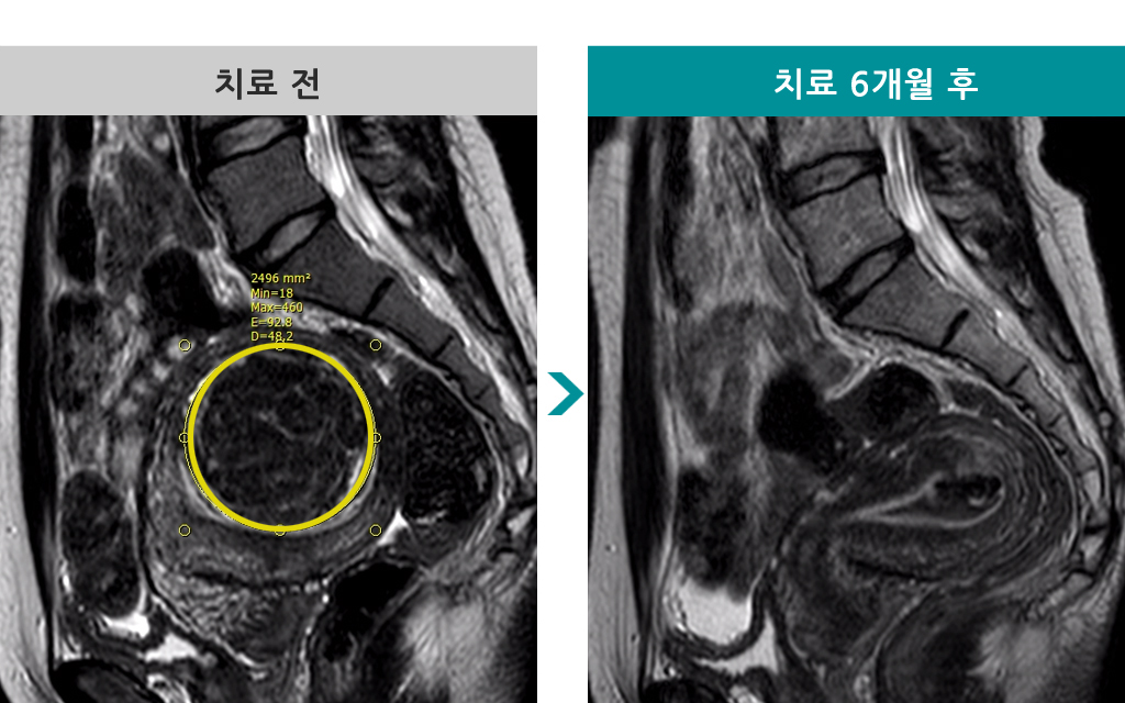 38세색전술6개월.jpg