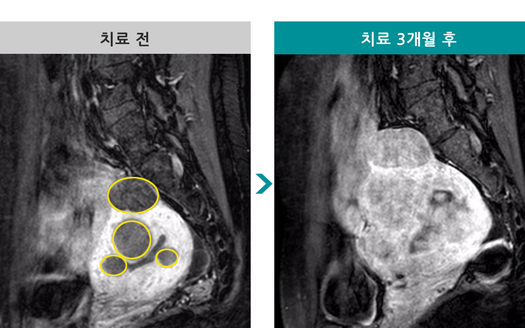 28세 색전술 00839616.jpg