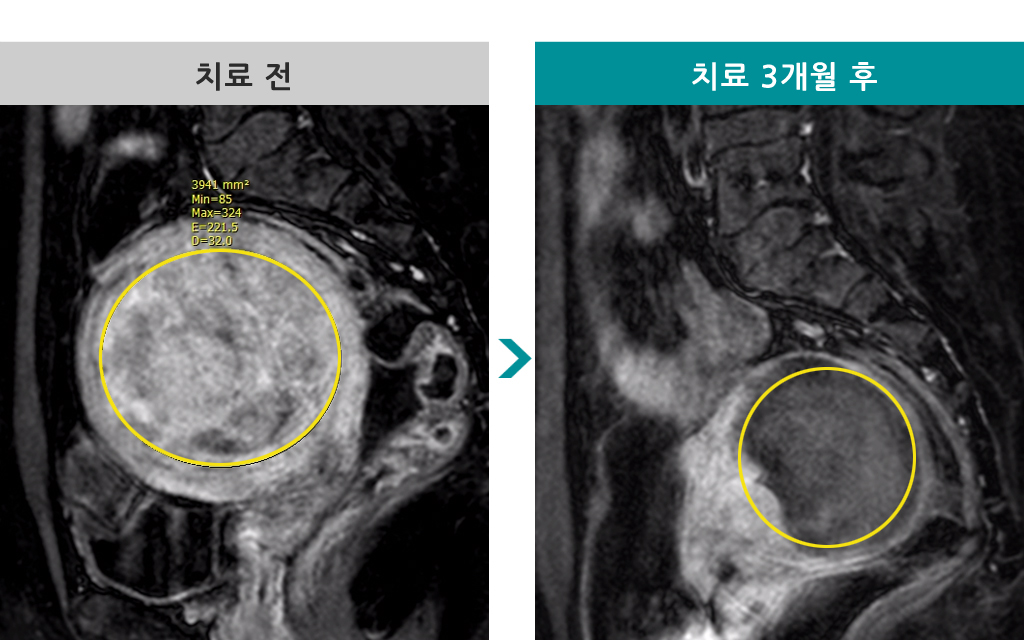 34세 색전술 00838134.jpg