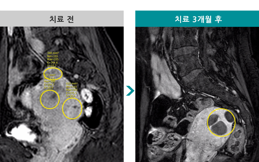 48세 색전술 00840519.jpg