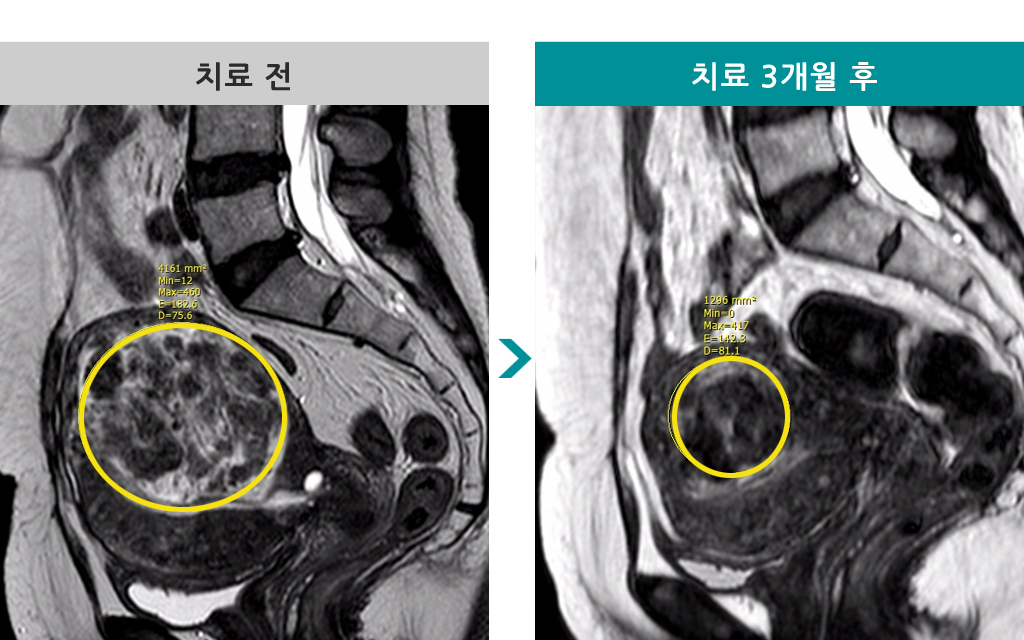 47세00840701색전술.jpg