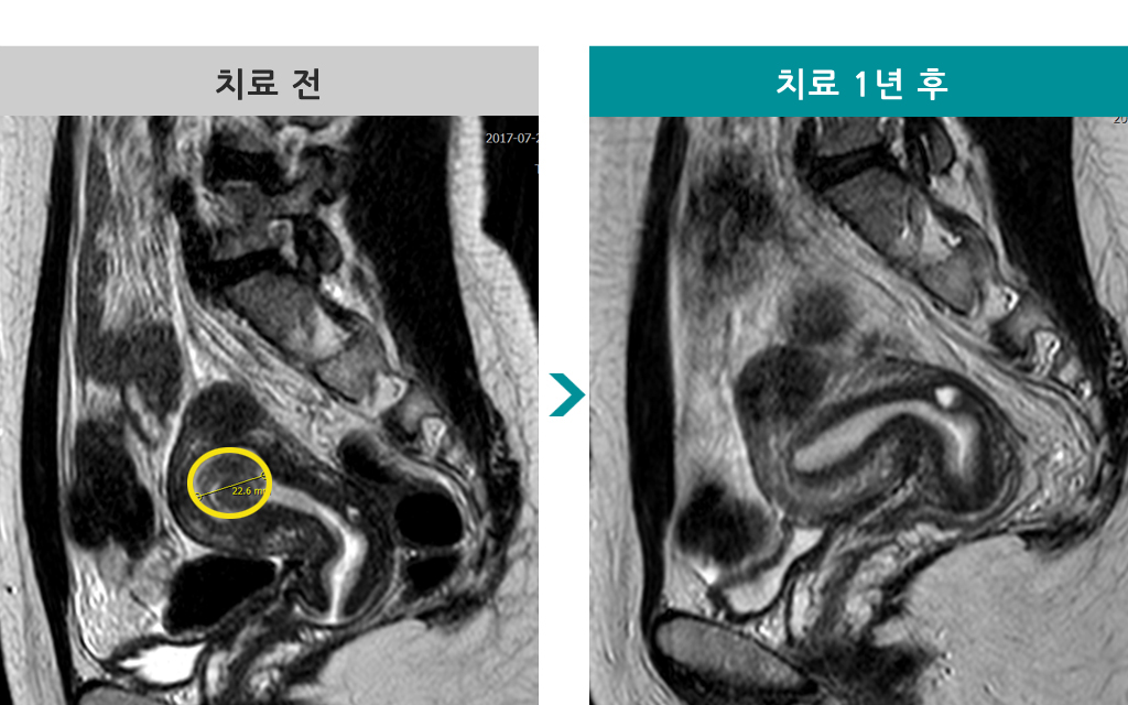 34세자궁경근종절제술.jpg