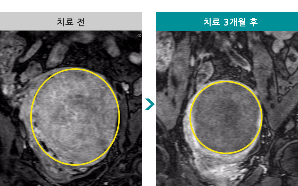 52세거대근종색전술.jpg