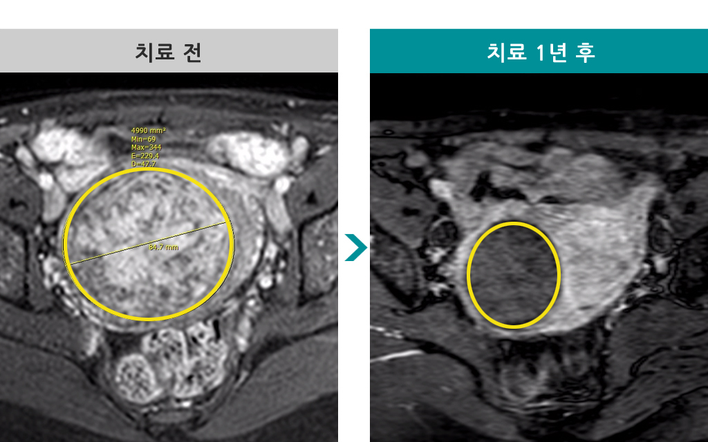 00832425색전술46세.jpg