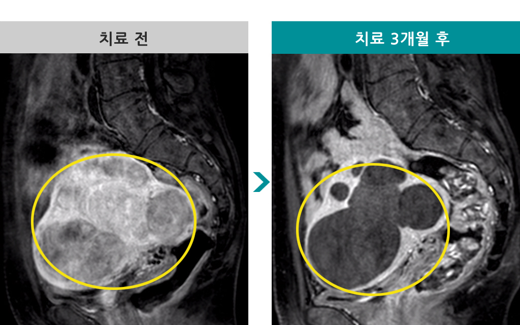 00832710색전술46세.jpg