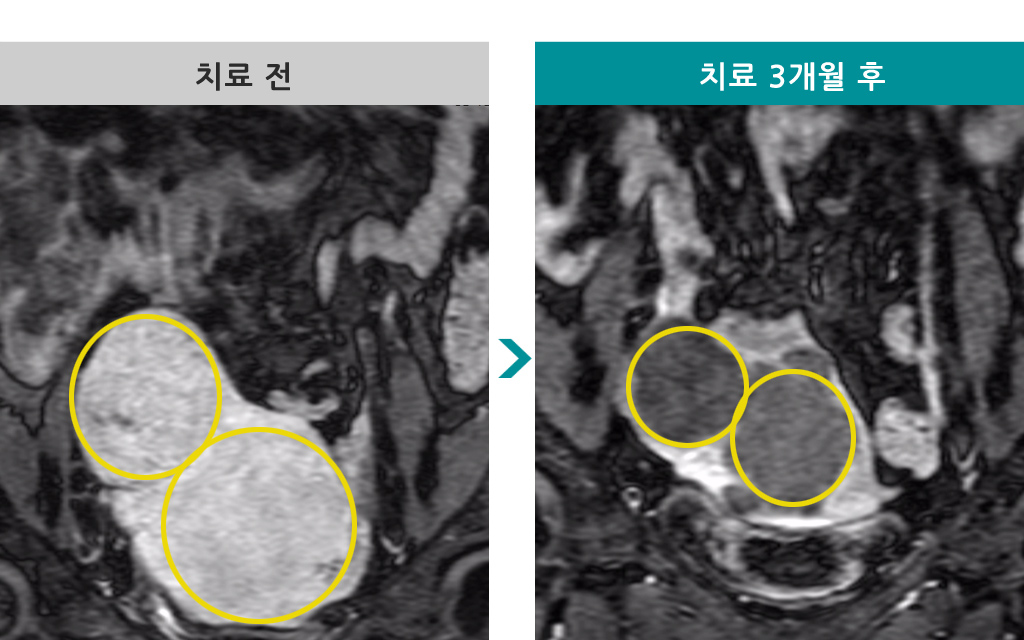 39세00833202자궁근종선근증.jpg