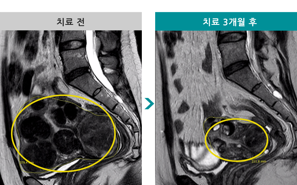 37세다발성근종00836695.jpg